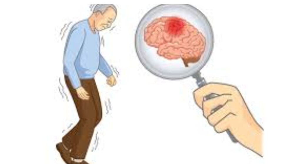 parkinson's disease treatment image