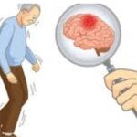 parkinson's disease treatment image