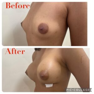  Plastic Surgery Cost Near Me In Hyderabad | Laser Liposuction Surgery in Personiks. 